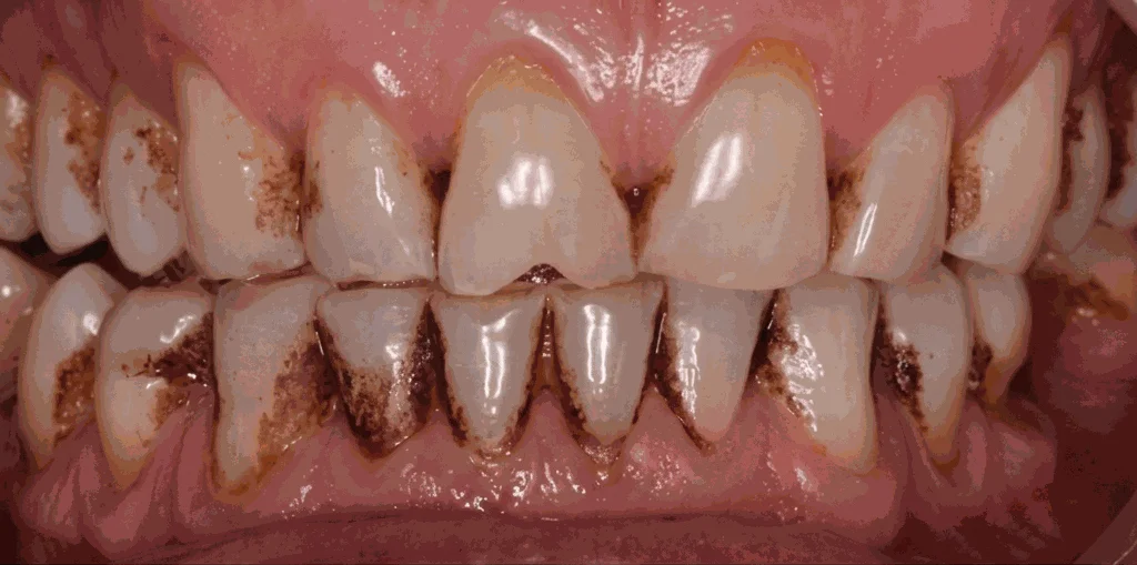 Avant détartrage : tartre accumulé sur les dents