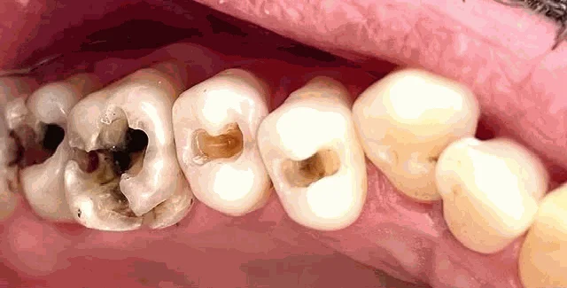 Avant restauration : dents abîmées